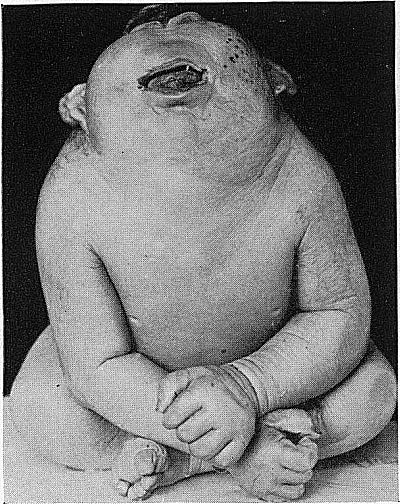 A Fetus with Cyclopia
