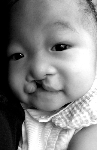 Cleft lip